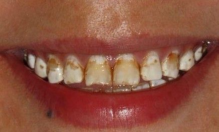 由此可见,氟斑牙这一类色素牙严重的影响患者生活,并